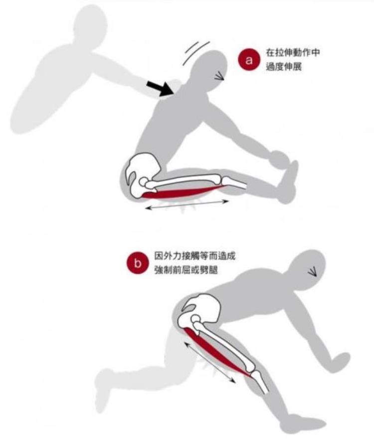 大腿后侧腘绳肌拉伤了,怎么办?,大腿腘绳肌肌腱拉伤