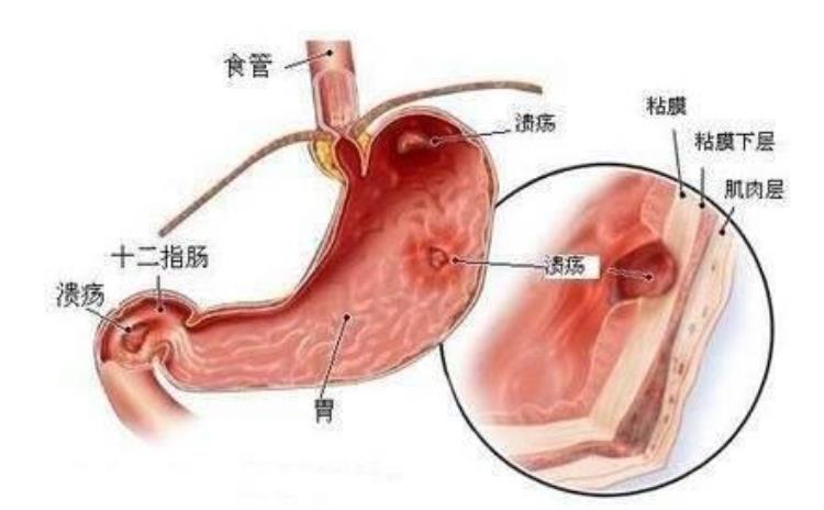 食管疼痛是克罗恩病吗