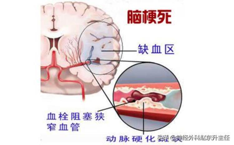 产生昏迷的原因,老人昏迷几天突然苏醒