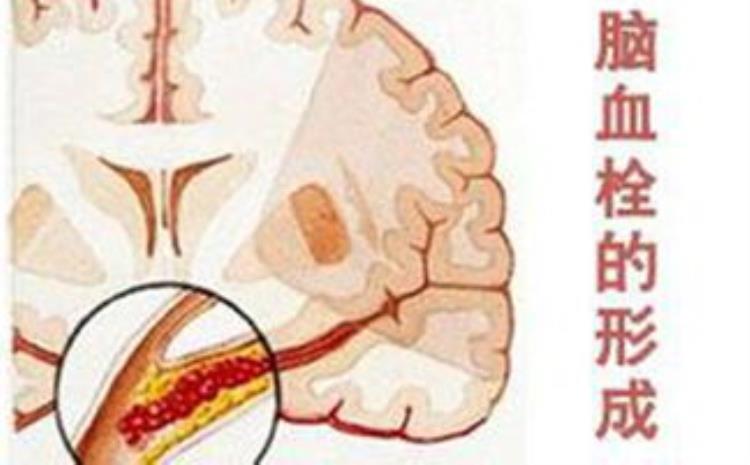 脑血栓栓在脑干了以后有啥症状,脑干血栓症状表现有哪些