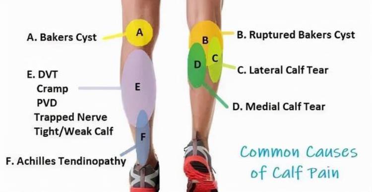 手法治疗师应该了解的小腿后肌群疼痛Calfmuscles常见原因