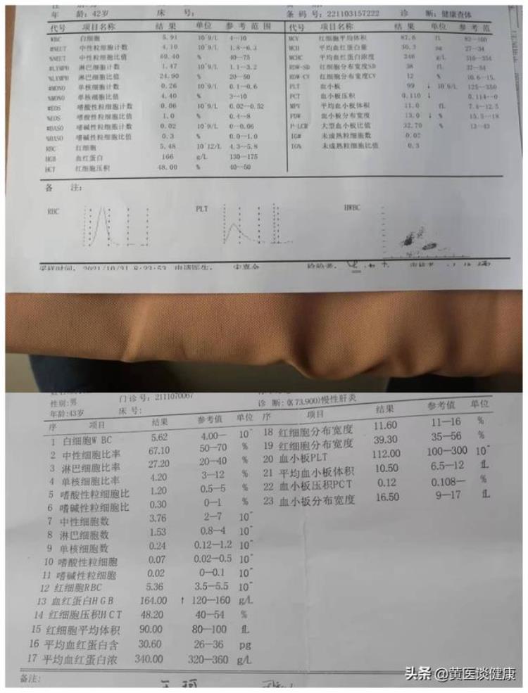 乙肝硬化脾大白细胞血小板减,乙肝肝硬化血小板低是怎么回事