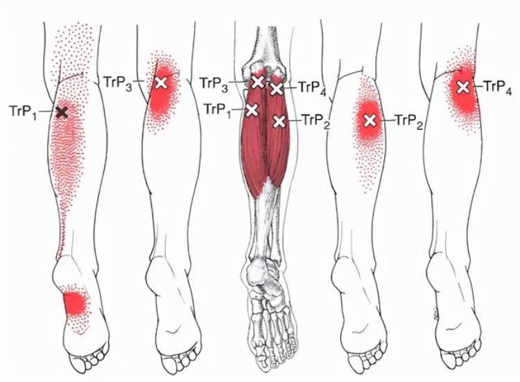 手法治疗师应该了解的小腿后肌群疼痛Calfmuscles常见原因