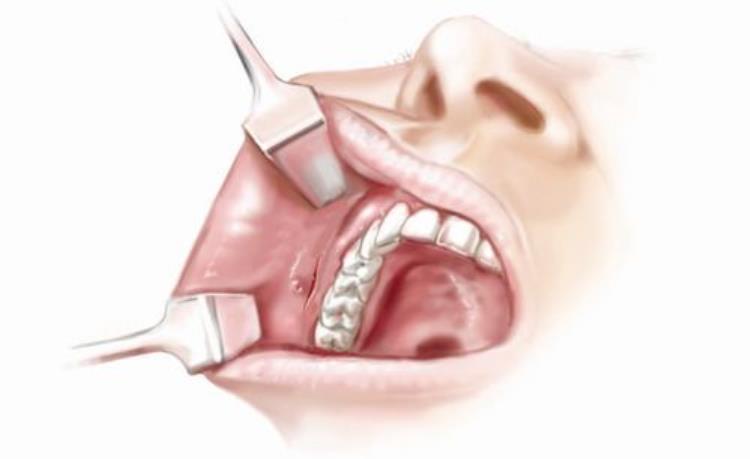 下颌角术后进食会影响手术伤口吗「下颌角术后进食会影响手术伤口吗」