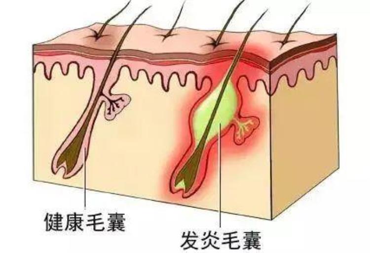 头皮起包发红怎么回事「头皮起包发红怎么回事」