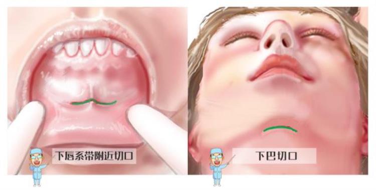 隆下巴整个过程「关于隆下巴你会想知道的那些事」