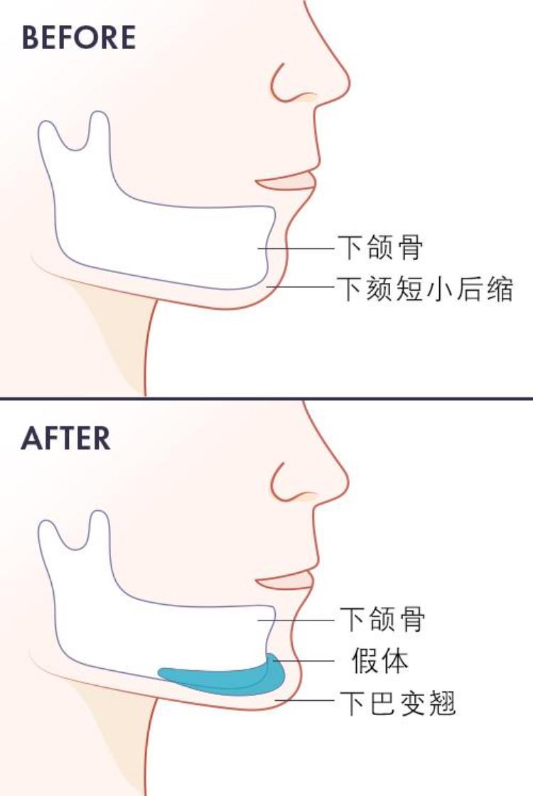隆下巴整个过程「关于隆下巴你会想知道的那些事」
