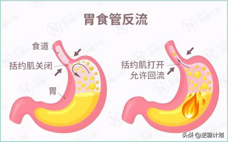 喉咙里老是感觉流酸水「经常感觉喉咙酸涩难忍似有酸水上涌那可要当心了」