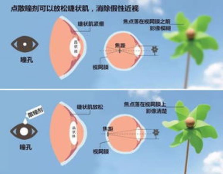 关于散瞳验光「散瞳验光你了解多少」