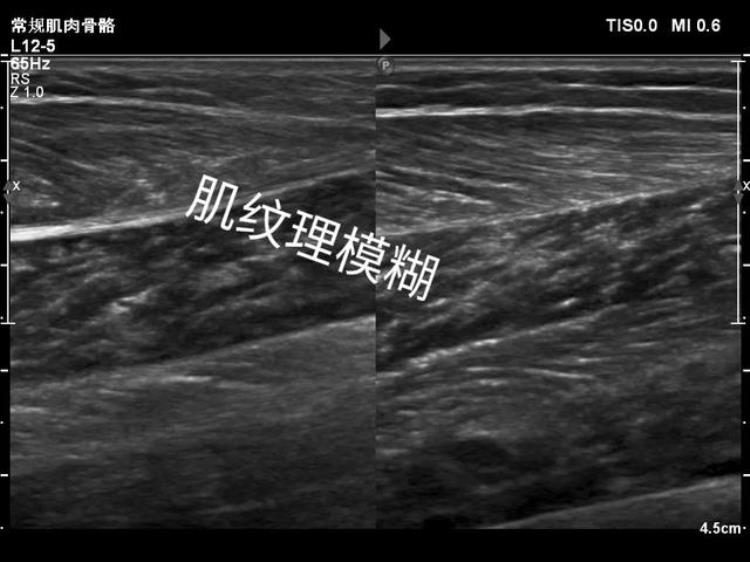 跳绳过程中跳着跳着小腿突然疼了咋回事「跳绳过程中跳着跳着小腿突然疼了咋回事」