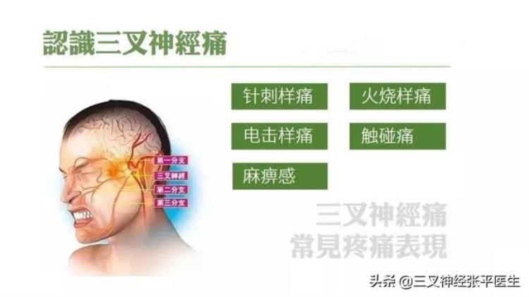 三叉神经痛发作时间是什么时候这篇文章给你讲清楚