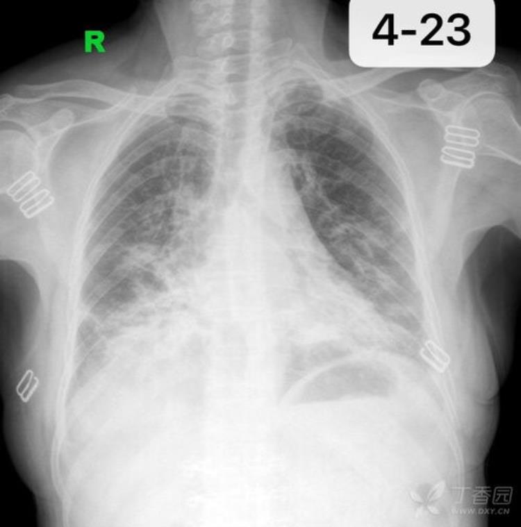 胸片如何看炎症一大批病例正在赶来医院「胸片如何看炎症一大批病例正在赶来」