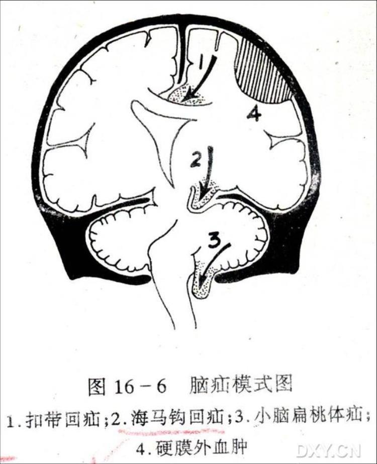 神经外科常见脑疝类型有「神经外科常见脑疝类型」