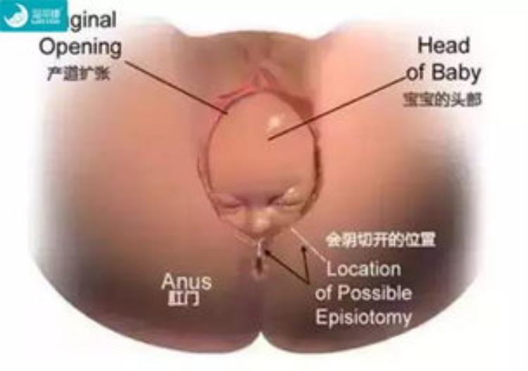 妇产科普为什么有些产妇要侧切手术「妇产科普为什么有些产妇要侧切」