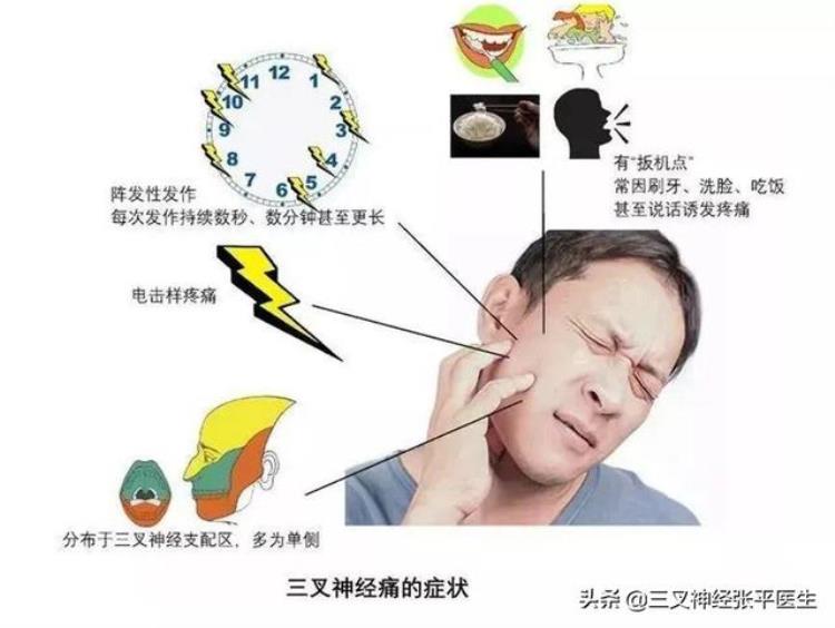 三叉神经痛发作时间是什么时候这篇文章给你讲清楚