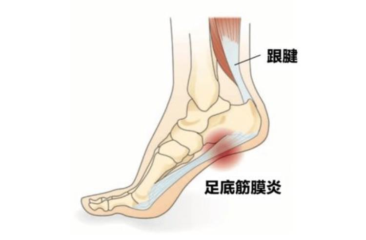 脚底受凉会引起足底筋膜炎吗「脚沾地就痛秋冬季好发足底筋膜炎」