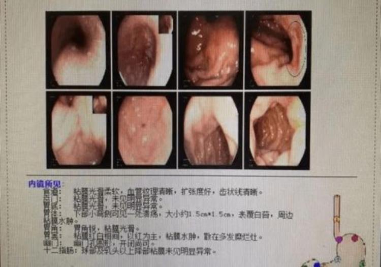 吹气检查幽门螺旋杆菌多少钱「吹气检查幽门螺旋菌要多少钱多在这个范围内无需过于担忧」