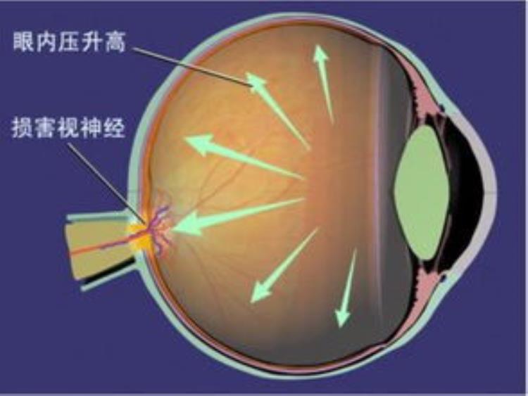 青光眼眼压是什么「青光眼是怎么回事眼压达到这个数值该警惕了」