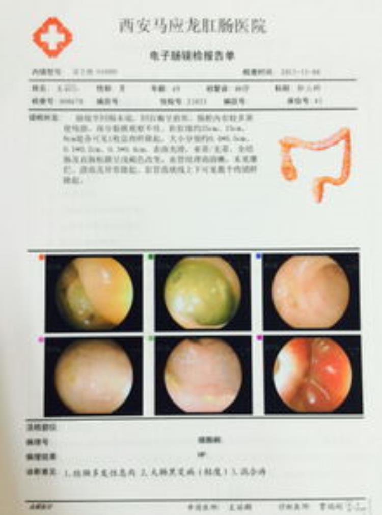 在新加坡做个肠胃镜费用竟高达1万新币多少「在新加坡做个肠胃镜费用竟高达1万新币」