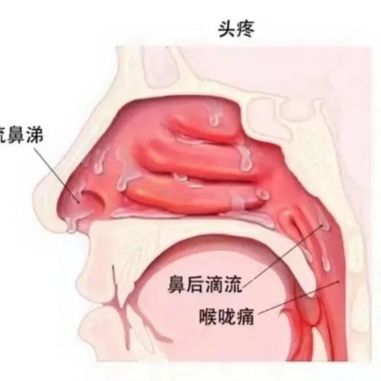 鼻涕倒流引起喉咙很痒有痰「鼻涕倒流导致喉咙有痰痒5招解决鼻涕倒流」