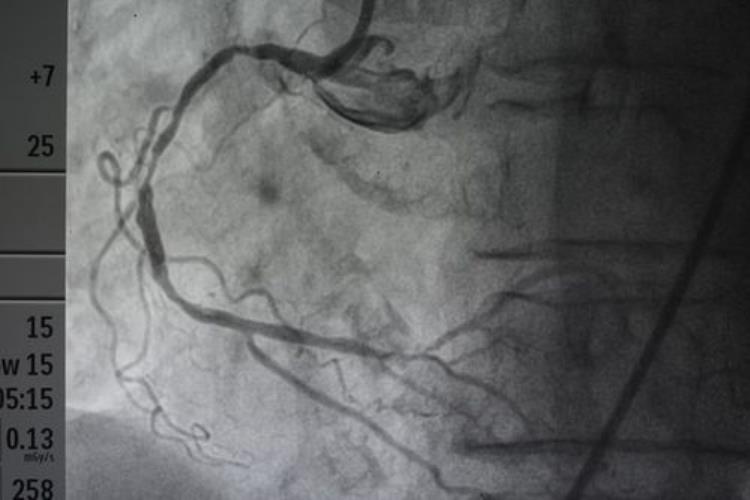 做心脏造影对身体有没有影响「心脏造影对身体有伤害吗是在哪穿孔医生这3种情况才建议做」