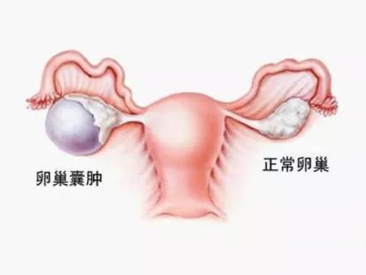 卵巢囊肿的检查费用是多少「卵巢囊肿的检查费用是多少」