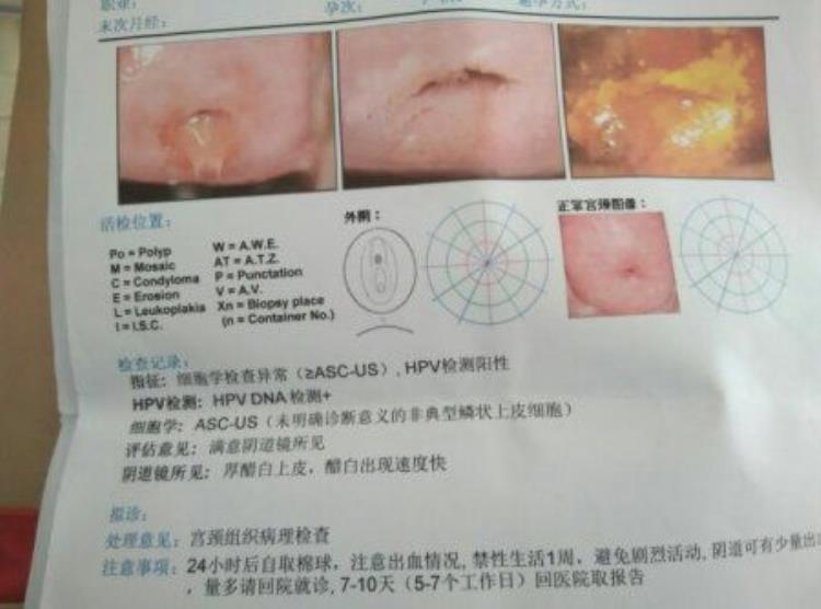 筛查宫颈癌tct和HPV哪个更准确「宫颈癌筛查TCT和HPV哪个更准确不同年龄选择不同」