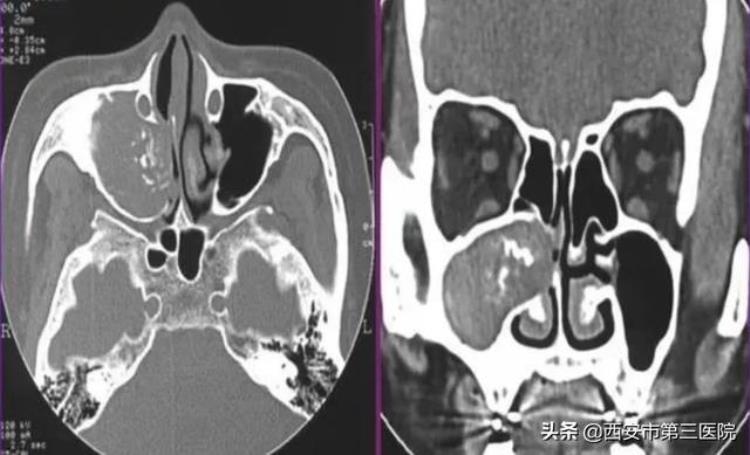 反复头痛!鼻腔异味!警惕真菌性鼻窦炎怎么办「反复头痛!鼻腔异味!警惕真菌性鼻窦炎」