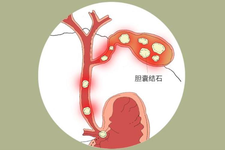 50岁左右的女性腰背疼痛是得了啥大病辗转三家医院才查出病因