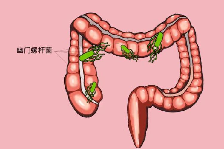 50岁左右的女性腰背疼痛是得了啥大病辗转三家医院才查出病因