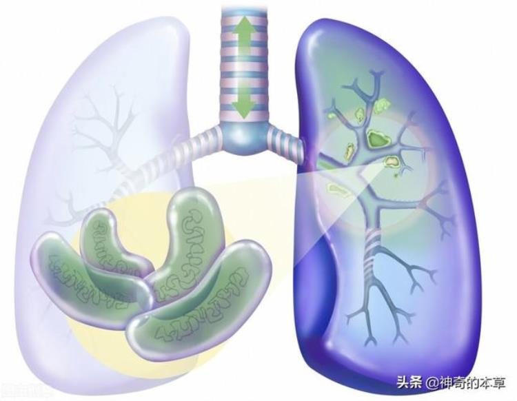 肺结核会引起什么并发症「肺结核可能会引起哪些并发症」