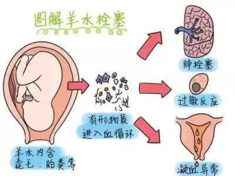 担心羊水栓塞「产妇突发羊水栓塞我来担保救人要紧」