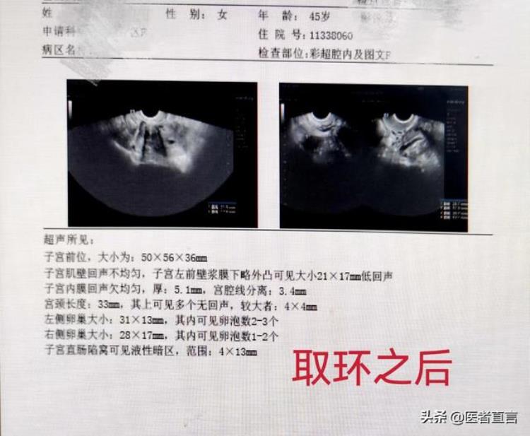 月经不干净带环有什么影响「月经一直不走竟是环惹的祸子宫里的环竟能扎破子宫」