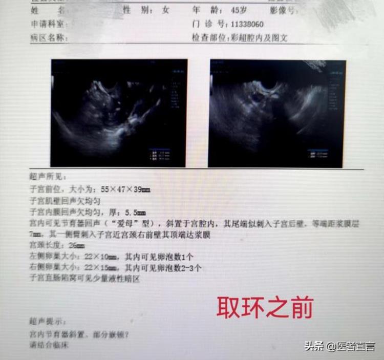 月经不干净带环有什么影响「月经一直不走竟是环惹的祸子宫里的环竟能扎破子宫」