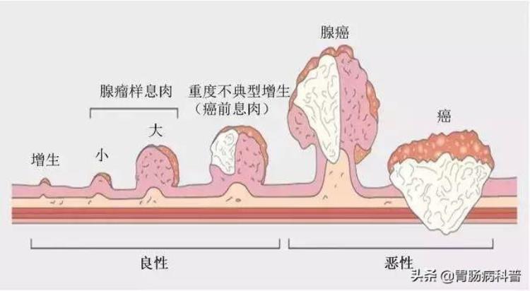 肠癌 傻子癌「肠癌就是个傻子癌患上真是太冤了」