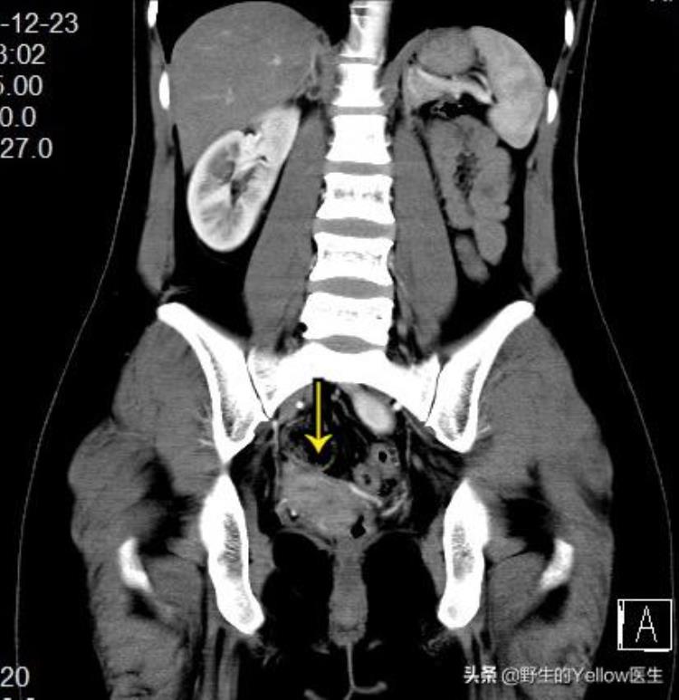 育龄期女性腹股沟突现包块这是怎么回事「育龄期女性腹股沟突现包块这是怎么回事」