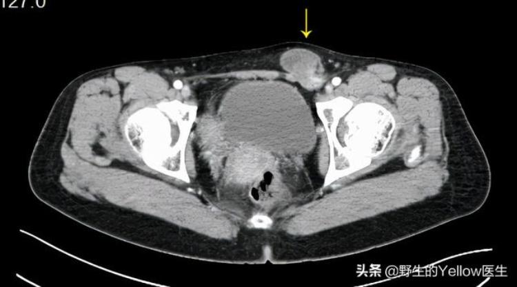 育龄期女性腹股沟突现包块这是怎么回事「育龄期女性腹股沟突现包块这是怎么回事」