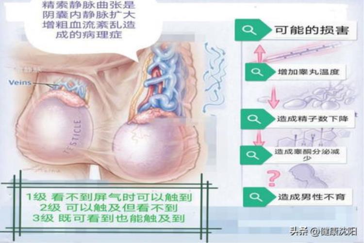 男性精索静脉曲张的危害「导致男性不育最常见的祸根原来是精索静脉曲张一文读懂」