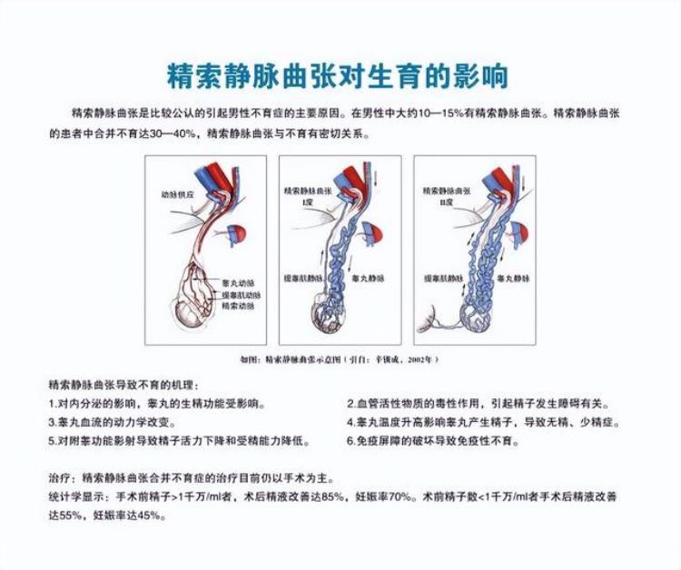 男性精索静脉曲张的危害「导致男性不育最常见的祸根原来是精索静脉曲张一文读懂」