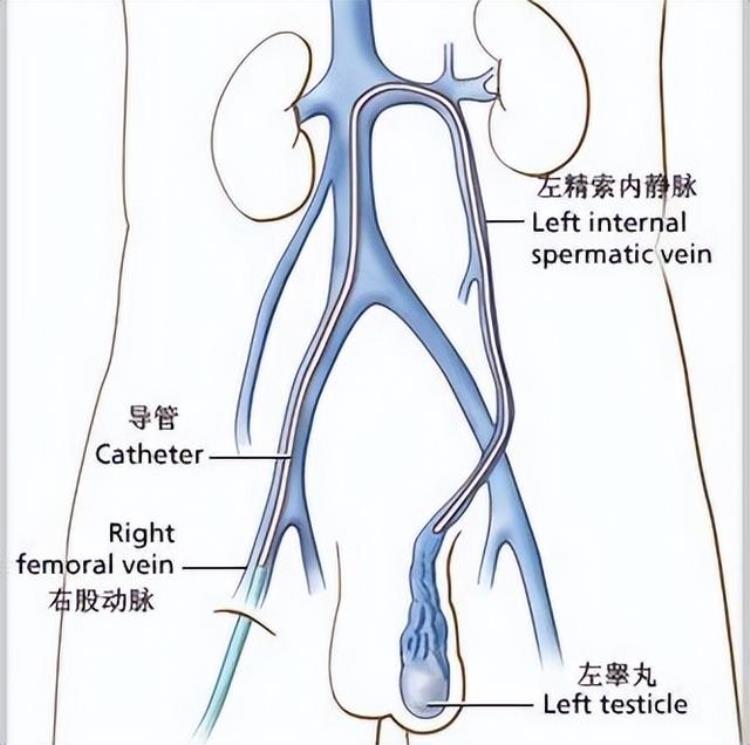 男性精索静脉曲张的危害「导致男性不育最常见的祸根原来是精索静脉曲张一文读懂」