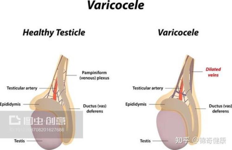 男性精索静脉曲张的危害「导致男性不育最常见的祸根原来是精索静脉曲张一文读懂」