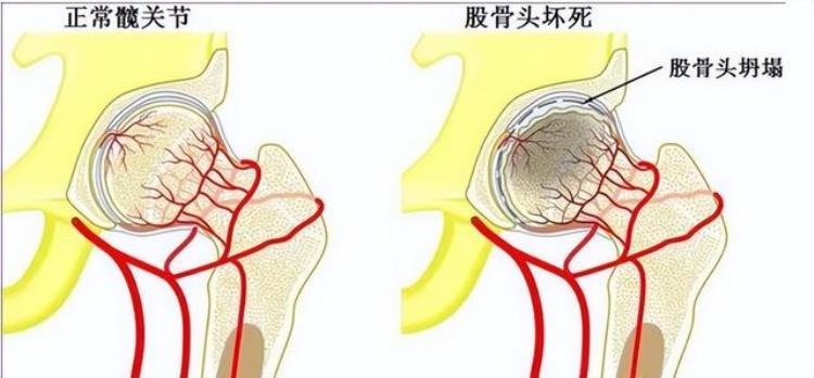 身体有病胯骨知道提醒总是胯骨痛或是这4种病的警报