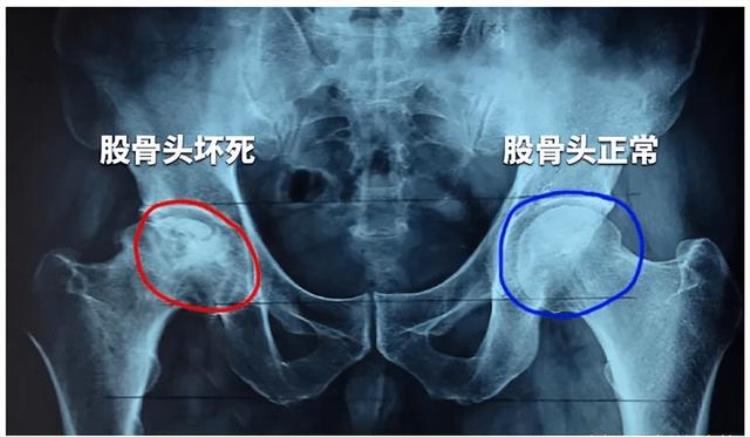 身体有病胯骨知道提醒总是胯骨痛或是这4种病的警报