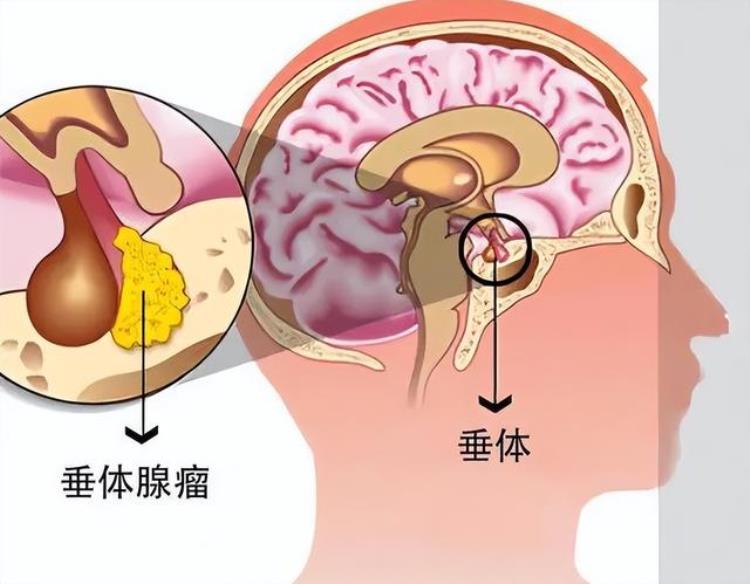 闭经泌乳不孕不可忽视的病因,闭经多久会出现不孕不育