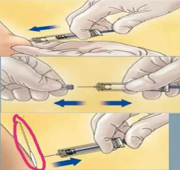 注射低分子肝素注意这些让护士不再对它爱恨交加