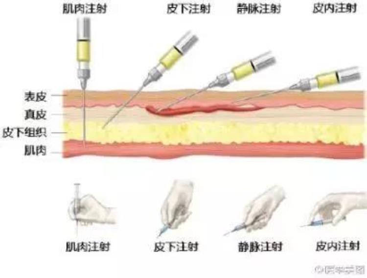 注射低分子肝素注意这些让护士不再对它爱恨交加