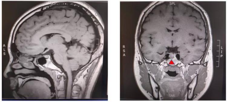 十二岁出现第二性征算性早熟吗,16岁姨妈三年前就来过还不正常