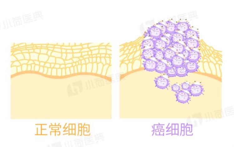 肺癌发病人数和死亡每年多少人「一年82万人发病65万人死亡癌症第一杀手肺癌是如何产生的」