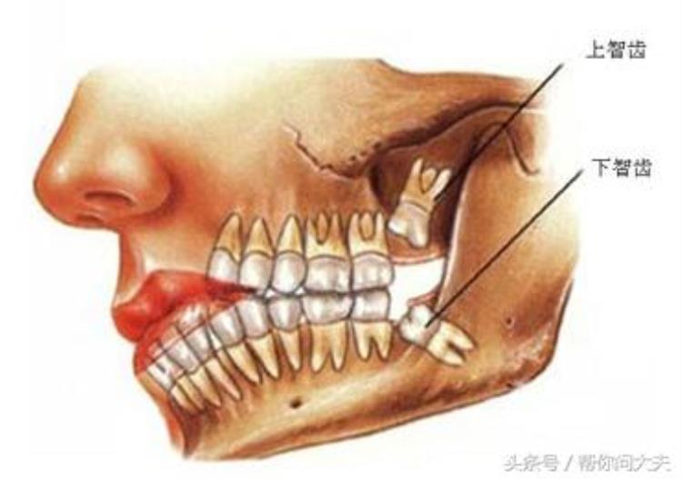 长智齿不痛就不用理他吗「长智齿不痛就不用管智齿的成因和危害你真的了解吗」