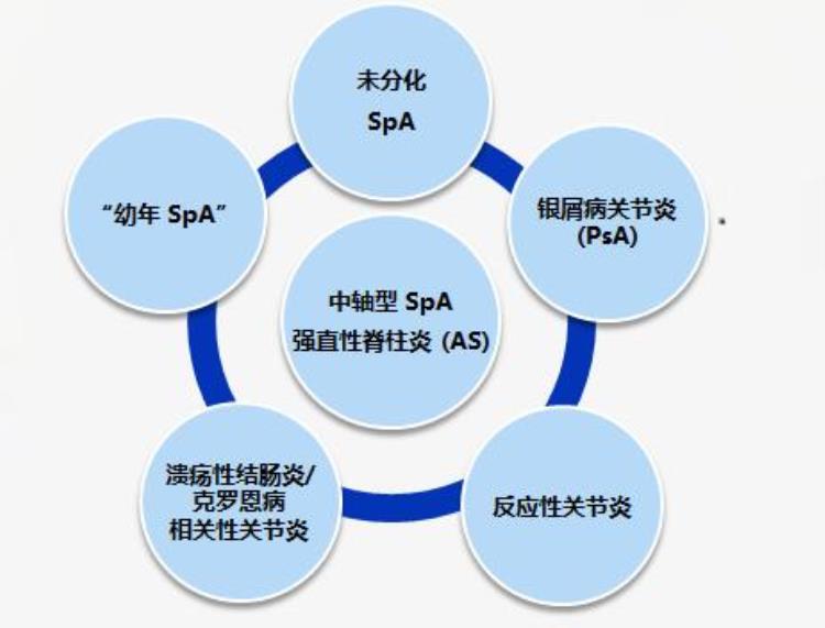 腰部反复疼痛核磁提示骶髂关节炎一定是强直性脊柱炎